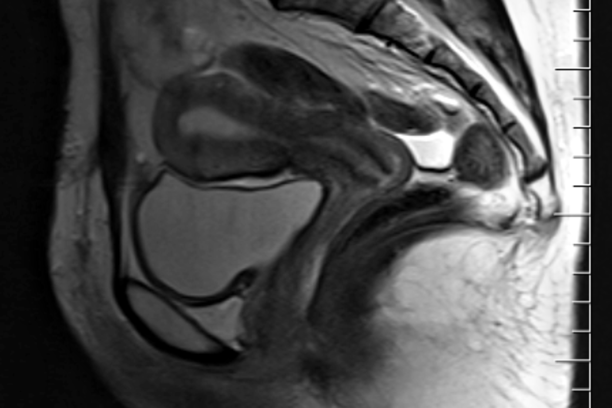 MRI image of the fm reproductive tract